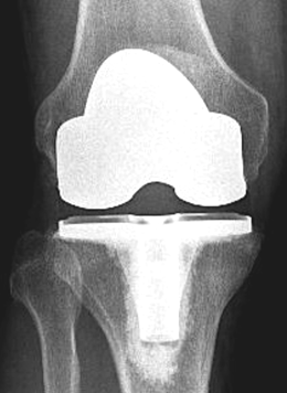 Total Knee Xray