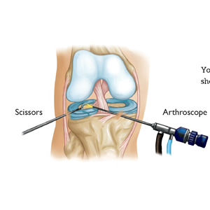 Knee Arthroscopy