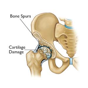 Hip Arthritis