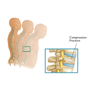 Osteoporosis